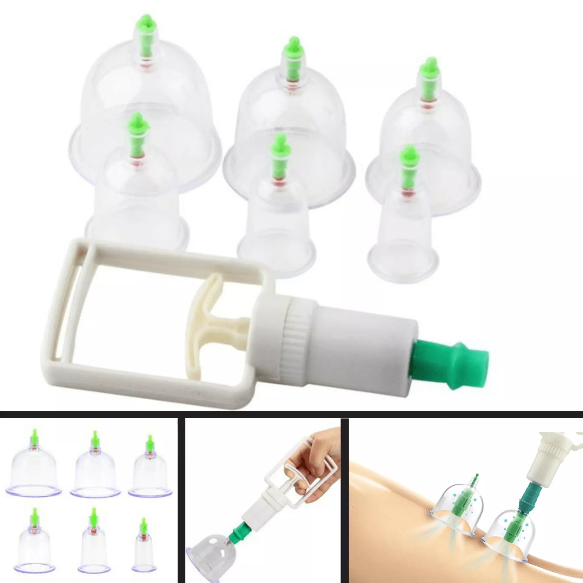 Vákuumterápiás készlet 6 haranggal / cellulit csökkentésre
